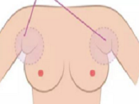 乳房再造